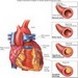 Ateroskleróza